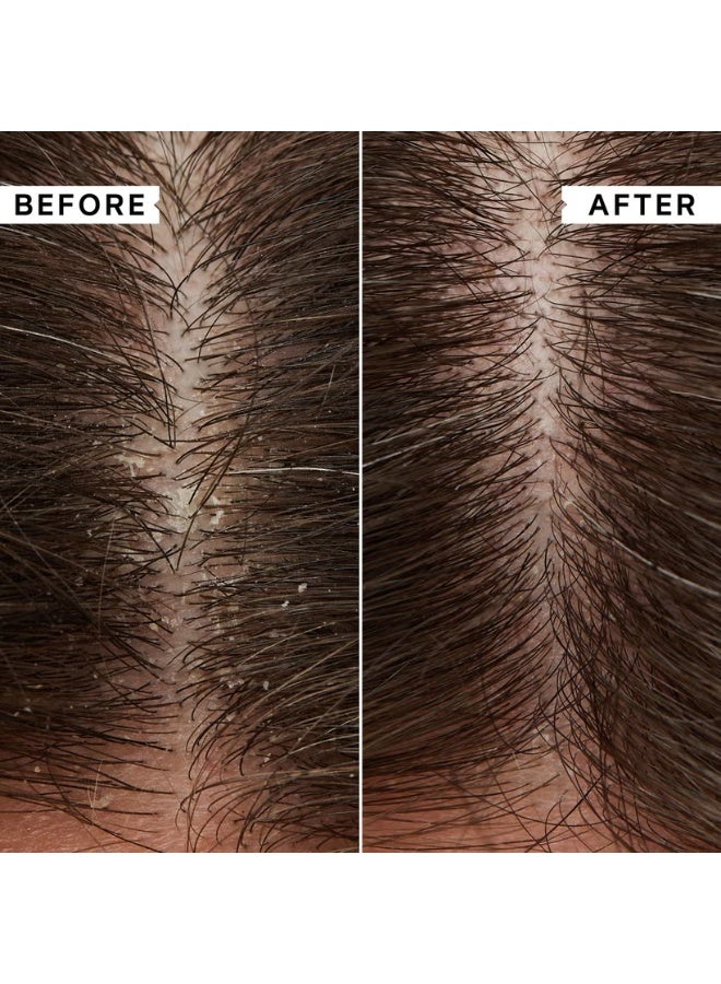 Philip Kingsley Flaky/Itchy Scalp 8-Day Kit - Image 2