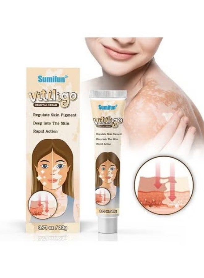 سوميفون كريم إزالة البهاق، علاج البهاق الجلدي، العناية بالبهاق كريم تقليل البقع البيضاء وتحسين تصبغ الجلد -20 غ - Image 1