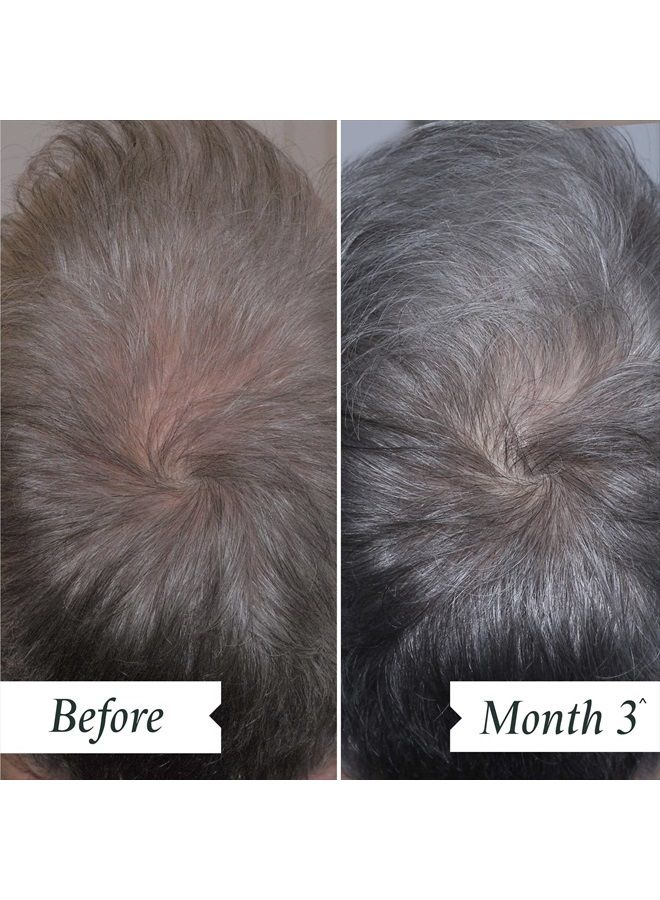 Philip Kingsley قطرات فروة الرأس من فيليب كينغسلي للحفاظ على كثافة الشعر - سيروم كثافة الشعر للشعر الخفيف وتساقط الشعر، منتجات العناية بفروة الرأس لتساقط الشعر والكثافة، 2.87 أونصة - Image 2