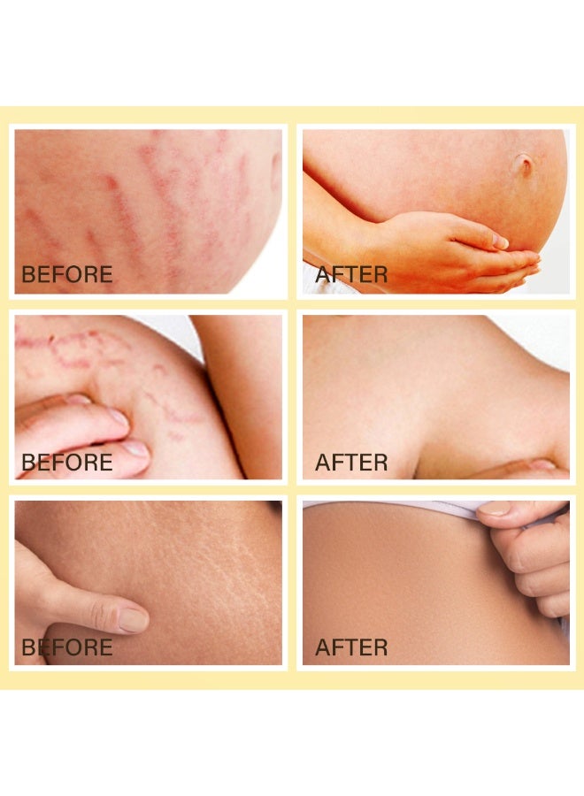 MOOYAM Stretch Mark Removal Oil with Vitamin E for Fading New Old Marks Improves Skin Elasticity Fast Absorbing Hydrating Body Treatment for Pregnancy and Weight Loss 100ml - Image 2