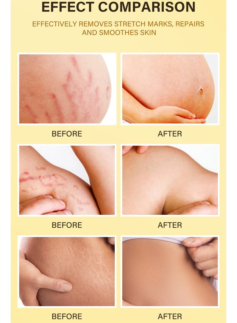 MOOYAM Stretch Mark Removal Oil with Vitamin E for Fading New Old Marks Improves Skin Elasticity Fast Absorbing Hydrating Body Treatment for Pregnancy and Weight Loss 100ml - Image 4