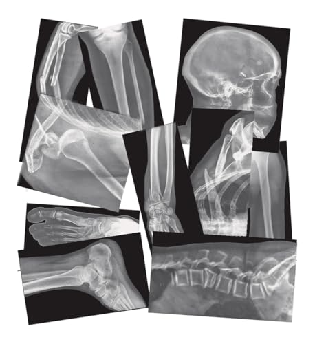 Roylco Broken Bones XRays  15 Piece Real Human Fracture XRay Set with Teaching Guide for STEMSTEAM Anatomy Biology Light Table  Classroom Science Learning - Image 1