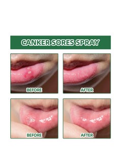 SOUTH MOON Canker Sore Treatment Spray 20ml，Herbal Ulcer Treatment,Natural Mouth Sore Relief for Daily Oral Care, Mouth Spray,Treat Mouth Ulcer,Effective Mouth Sore Treatment  - Image 3