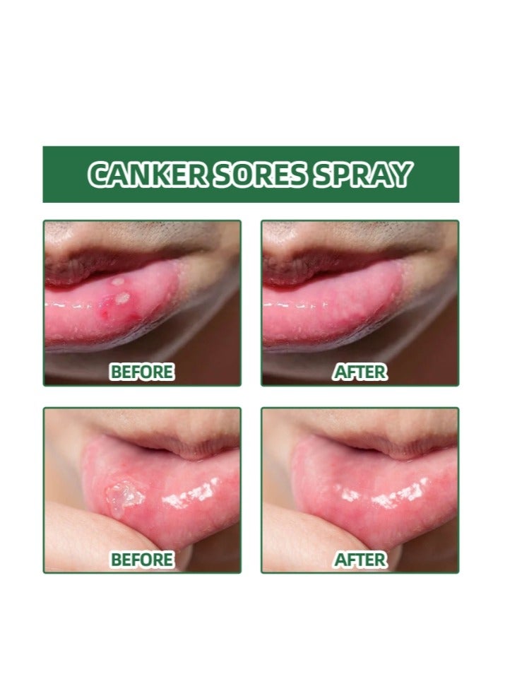 SOUTH MOON Canker Sore Treatment Spray 20ml，Herbal Ulcer Treatment,Natural Mouth Sore Relief for Daily Oral Care, Mouth Spray,Treat Mouth Ulcer,Effective Mouth Sore Treatment - Image 3