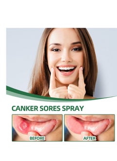 SOUTH MOON Canker Sore Treatment Spray 20ml，Herbal Ulcer Treatment,Natural Mouth Sore Relief for Daily Oral Care, Mouth Spray,Treat Mouth Ulcer,Effective Mouth Sore Treatment  - Image 4