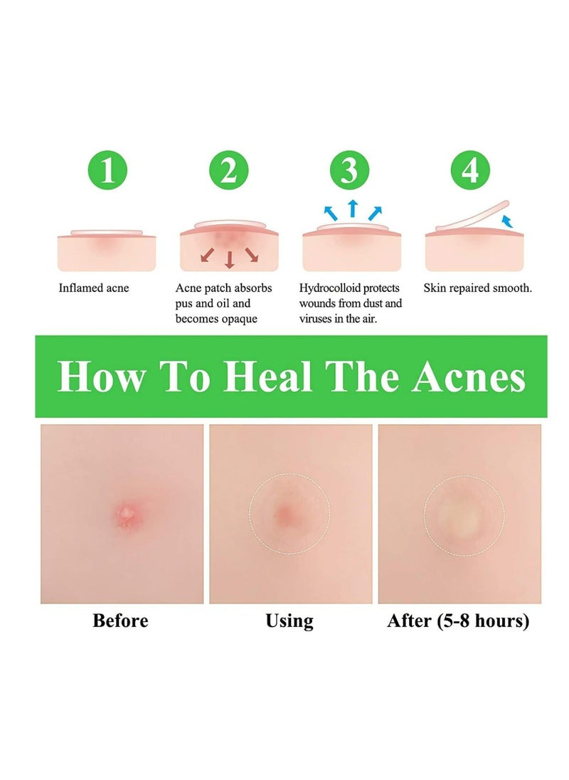 Breylee 22-Piece Invisible Acne Pimple Patch Set Clear  - Image 5