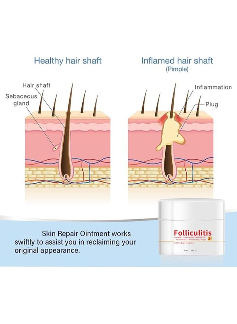 HaLunhi - Folliculitis, Folliculitis Treatment, Lichen, Folliculitis Cream, Scalp Psoriasis Treatment, Seborrheic Dermatitis Treatment, Dry Itchy Scalp Treatment, Dandruff Treatment - Safe and Fast - Image 1