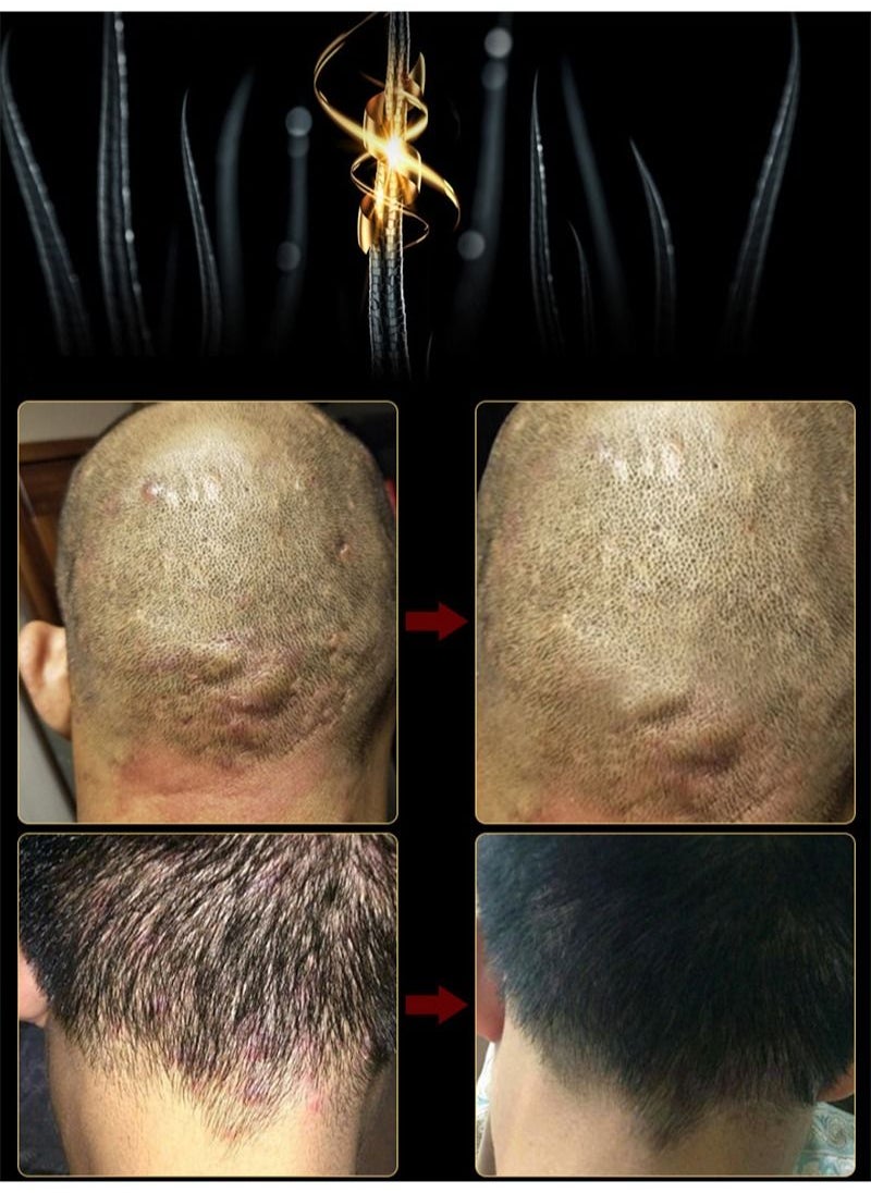 HaLunhi - Folliculitis, Folliculitis Treatment, Lichen, Folliculitis Cream, Scalp Psoriasis Treatment, Seborrheic Dermatitis Treatment, Dry Itchy Scalp Treatment, Dandruff Treatment - Safe and Fast - Image 1