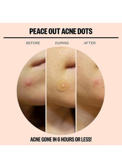 PEACE OUT PEACE OUT Skincare Acne Dots, Hydrocolloid Pimple Patches Help Clear Blemishes Overnight, Award Winning Fast Acting Anti-Acne Solution (20 dots)  - Image 3