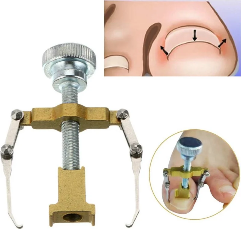 بروايثالات Professional Ingrown Nail Correction Device