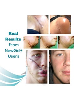 NewGel+ جل سيليكون متطور لعلاج الندبات 30 جرام  - Image 5