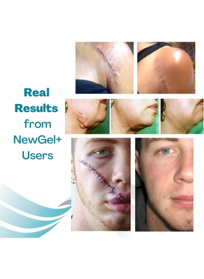 NewGel+ - Advanced Silicone Gel for Scar Treatment 30 grams - Image 1