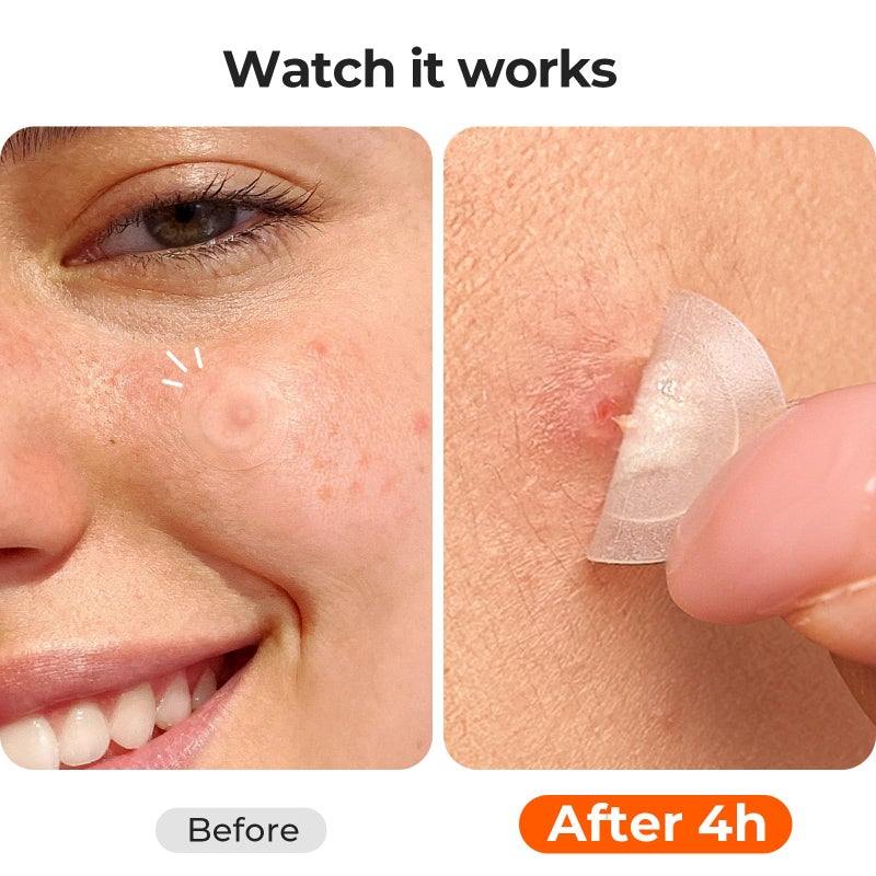 TKTK Pimple Patches for Face, 0.01cm Ultra-Thin Invisible Acne Patches, Hydrocolloid Patches for Breakouts, Absorbs Zits & Blemish, Suitable Under Makeup, 2 Sizes(10mm/12mm) 168 count - Image 3