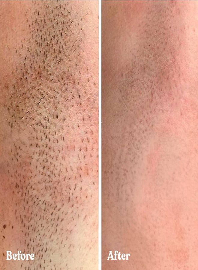 بومباي بودرة بومباي العشبية لإزالة الشعر للنساء | بودرة إزالة شعر البكيني | إزالة الشعر للنساء | بودرة إزالة الشعر لمنطقة البكيني - Image 5