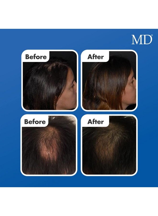 MD Factor Natural Hair Growth Serum ; Follicle Energizer Serum Prevents Thinning Hair & Hair Loss By Stimulating Hair Follicles To Produce Thicker Fuller Hair (30Day Supply Per Tube) - Image 5