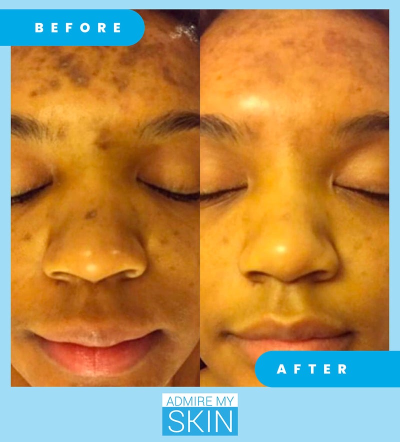 Admire My Skin Dark Spot Corrector Remover for Face - Brightening Discoloration Correcting Serum - Kojic Acid + Azelaic Acid Serum for Melasma and Sun Spots 1oz - Image 3