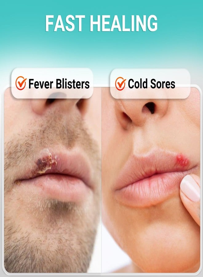 ishancare كريم إيشان كير لعلاج قروح البرد، راحة سريعة، ترطيب مهدئ، تركيبة محمولة ومضادة للحساسية لشفاه صحية 0.36 أونصة (10 غرام) - Image 2
