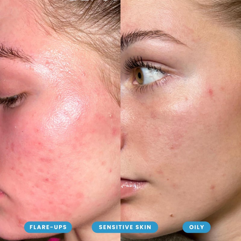 Honeydew Labs Hypochlorous Acid Spray â€“ Dermatologist Tested HOCl Facial Cleanser for Sensitive, Acne-Prone & Irritated Skin â€“ Soothes Redness, Eczema, Rashes & Itching â€“ Skin Repair Spray, 6.8 oz - Honeydew Labs - Image 3