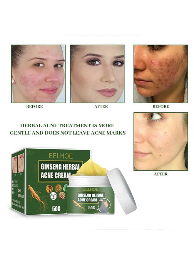 EELHOE Herbal Anti-Acne Cream Removes Acne, Lightens Acne Scars, Moisturizes and Hydrates Cleansing Cream Water and Oil Balance Anti-Acne Cream - Image 4