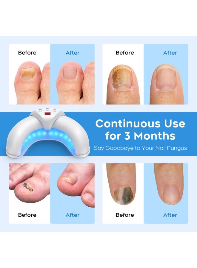 كيلا جهاز ليزر لعلاج فطريات الأظافر لأظافر القدمين واليدين المتعددة، محلول لإصلاح الأظافر التالفة والمتغيرة اللون، مناسب للاستخدام المنزلي - Image 3