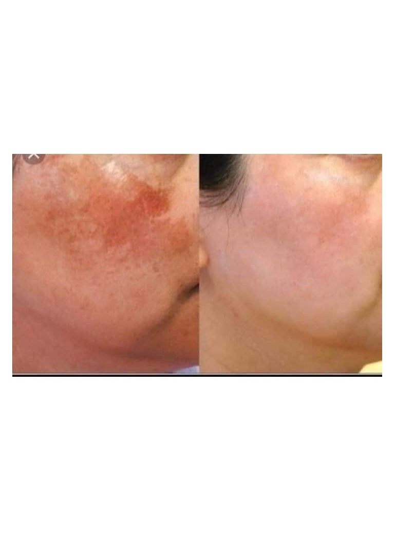 CADILA - Indian Skin Shine Cream for the treatment of melasma and acne 30 gm - Image 1