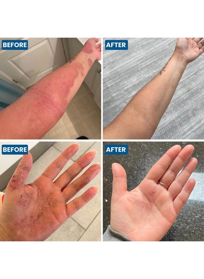 Grahams Natural C+ Eczema Cream Dermatitis Treatment - Lotion for Extremely Dry Skin, Inflammation, Redness & Itch Relief - Manuka Honey & Calendula - Clinically Proven - Steroid-Free (1 x 1.76oz)  - Image 4
