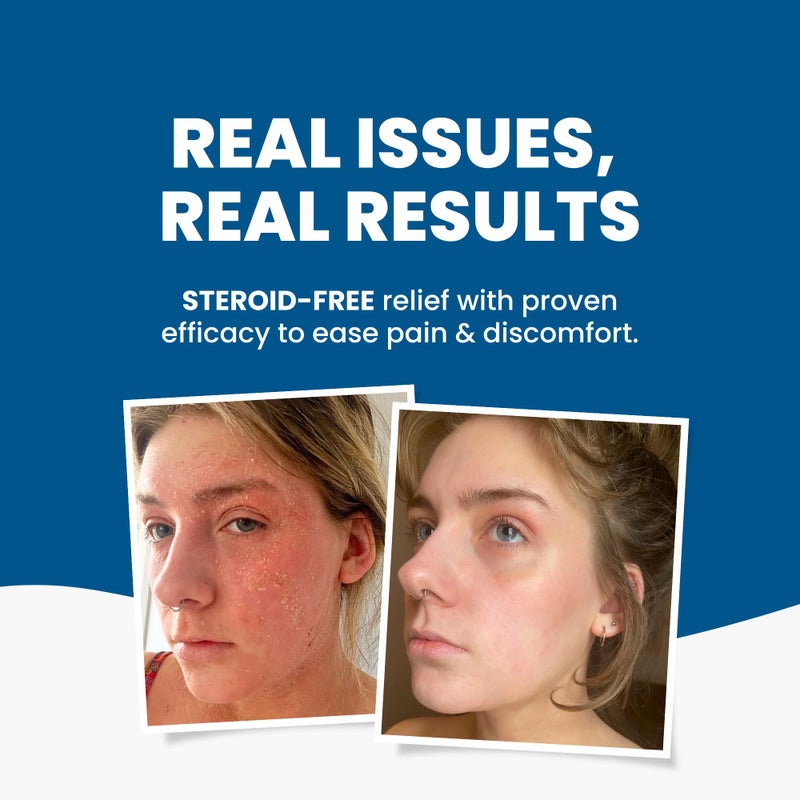 Grahams Natural C+ Eczema & Dermatitis Cream - All-Natural & Steroid-Free - Manuka Honey & Calendula - Clinically Proven Eczema Cream - Moisturizing Lotion for Extremely Dry Skin, Itch Relief (1.76oz) - Image 3