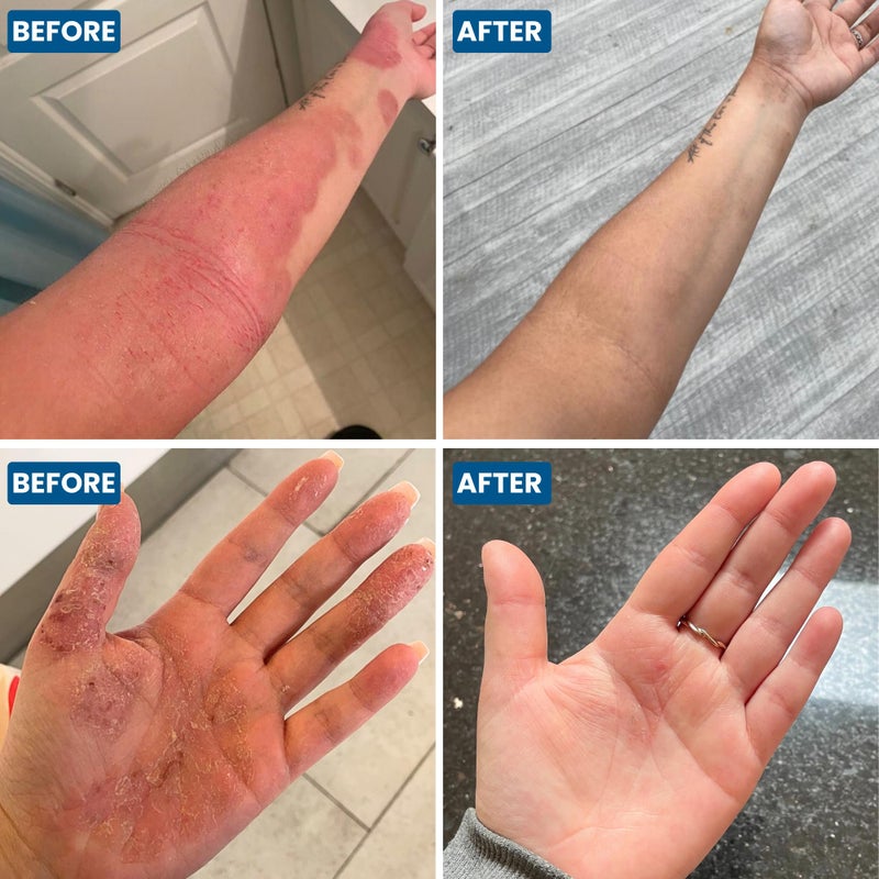 Grahams Natural C+ Eczema & Dermatitis Cream - All-Natural & Steroid-Free - Manuka Honey & Calendula - Clinically Proven Eczema Cream - Moisturizing Lotion for Extremely Dry Skin, Itch Relief (1.76oz) - Image 4