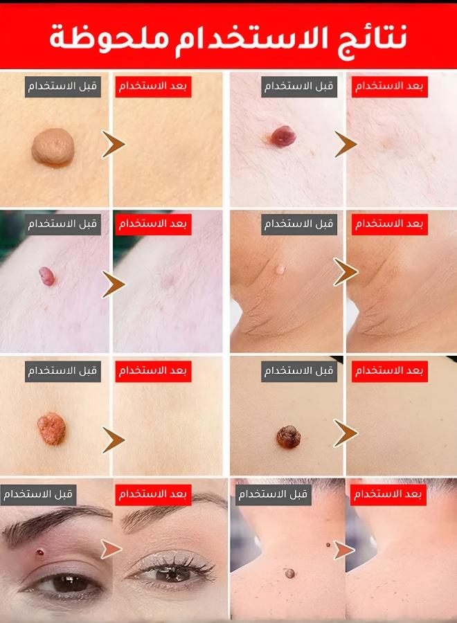 أداة العناية بالبشرة لإزالة الثآليل بالضوء الأزرق مع كريم إصلاح الندوب هدية - Image 4