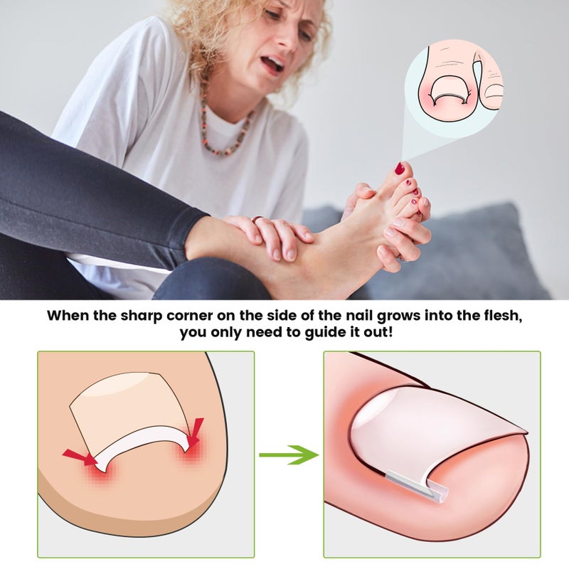 BEZOX Ingrown Toenail Corrector Set - 40 Pcs Pain-Free Toenails Straightener Strips with Toe Nail Lifter - Easy Use Ingrown Toenail Tools Kit - Image 2