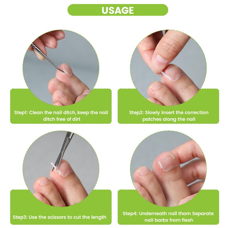 BEZOX Ingrown Toenail Corrector Set - 40 Pcs Pain-Free Toenails Straightener Strips with Toe Nail Lifter - Easy Use Ingrown Toenail Tools Kit - Image 3