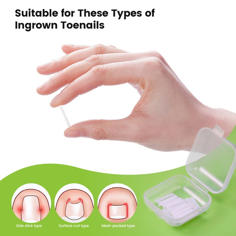 BEZOX Ingrown Toenail Corrector Set - 40 Pcs Pain-Free Toenails Straightener Strips with Toe Nail Lifter - Easy Use Ingrown Toenail Tools Kit - Image 4