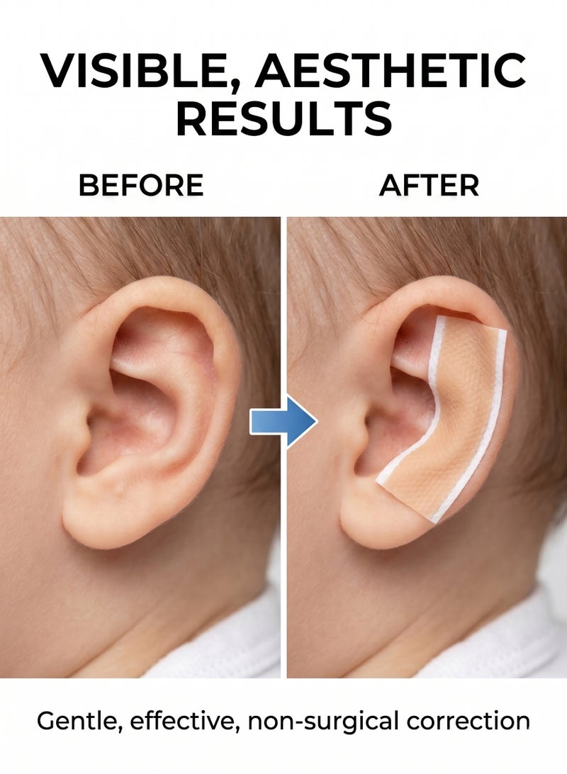 AceLuste Medical Grade Auricle Valgus Correction Patch for Baby, Infant Children Ear Correction Patch, Baby Silicone Gel Ear Tape, Newborn Baby Ear Aesthetic Correctors for Sleeping(4cm*100cm) - Image 2