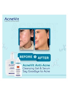 Acnevit Anti-Acne Serum 20Ml - pzsku/Z44FEAF33C537E5F330BEZ/45/_/1722332525/0d5f115d-d5a0-4ccf-b5bd-c5afb336c3cf