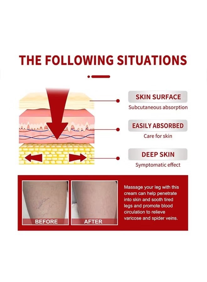 SOUTH MOON Varicose Veins Cream，Relieve Tired Legs Relieve Dilated Capillaries Minimize Varicose &Spider Veins ​Relief Cream 20g - Image 5