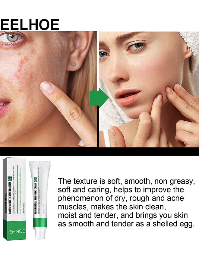 EELHOE Acne Removal Treatment Cream, Oil Control Acne Removal Acne Pimple Repair Cream, Acne Spot Treatment For Face And Acne Dots, Natural Cystic Acne Treatment Suitable For Oily And Acne Prone Skin 20G - Image 2