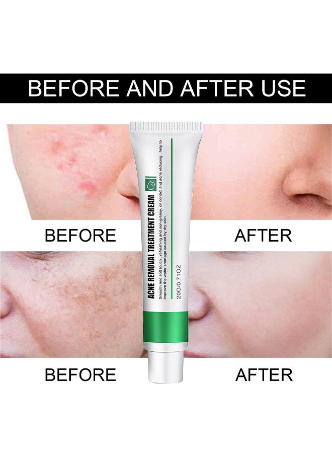 EELHOE Acne Removal Treatment Cream, Oil Control Acne Removal Acne Pimple Repair Cream, Acne Spot Treatment For Face And Acne Dots, Natural Cystic Acne Treatment Suitable For Oily And Acne Prone Skin 20G  - Image 4