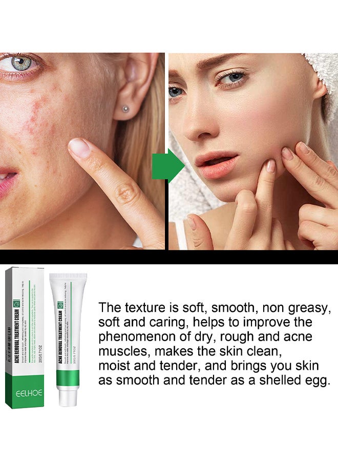 EELHOE Acne Removal Treatment Cream, Oil Control Acne Removal Acne Pimple Repair Cream, Acne Spot Treatment For Face And Acne Dots, Natural Cystic Acne Treatment Suitable For Oily And Acne Prone Skin 20G  - Image 2