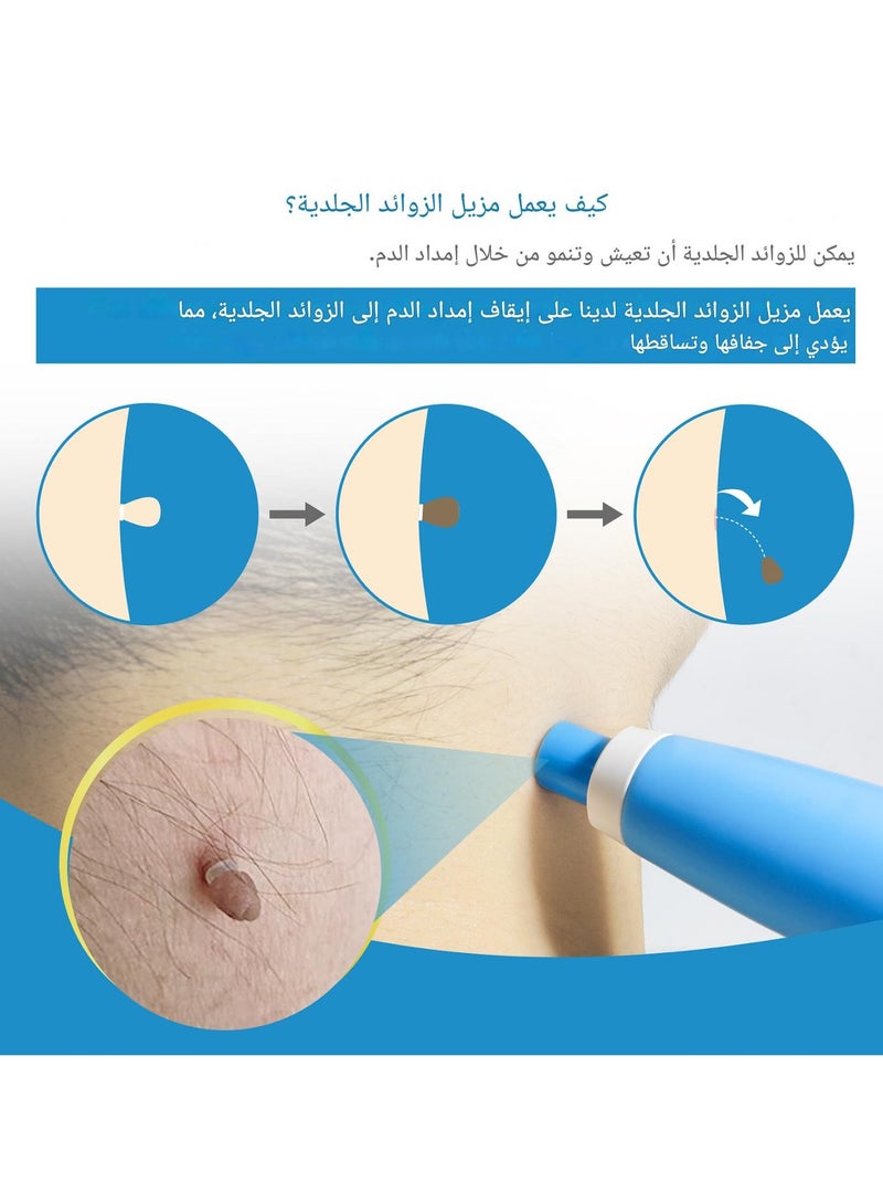 Skin Tag Removal Tool Kit Painless Skin Tag Removal Acne Wart Remover Handpiece with Cleansing Pads Facial Skin Care Tool Blue - Image 3