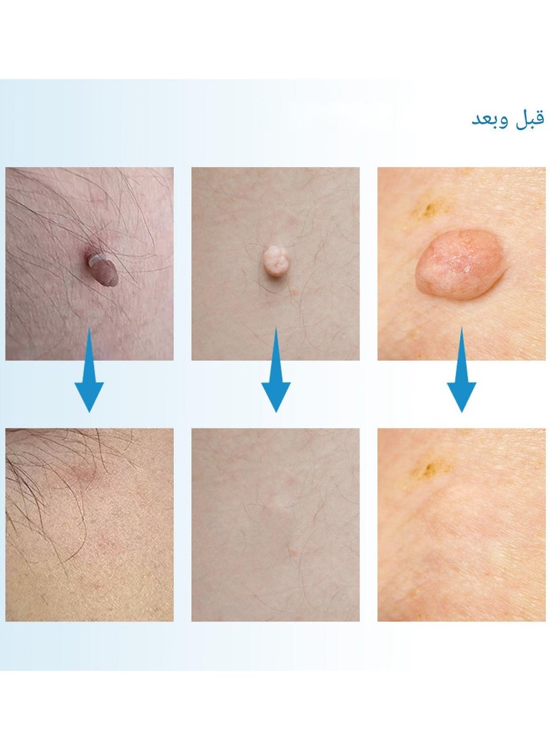 Skin Tag Removal Tool Kit Painless Skin Tag Removal Acne Wart Remover Handpiece with Cleansing Pads Facial Skin Care Tool Blue - Image 4