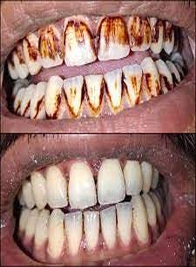 Nanni - Herbal Teeth Stain Remover | Tobacco Stain Remover | Freshens Laugh by Herbal - Image 3