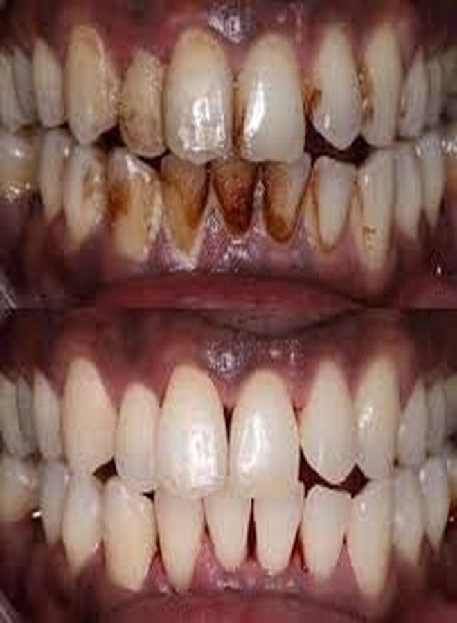 Nanni - Herbal Teeth Stain Remover | Tobacco Stain Remover | Freshens Laugh by Herbal - Image 1