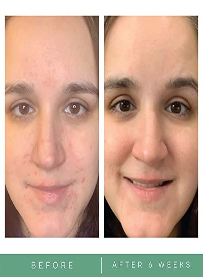 Replenix Benzoyl Peroxide 5% Acne Wash  - Image 4