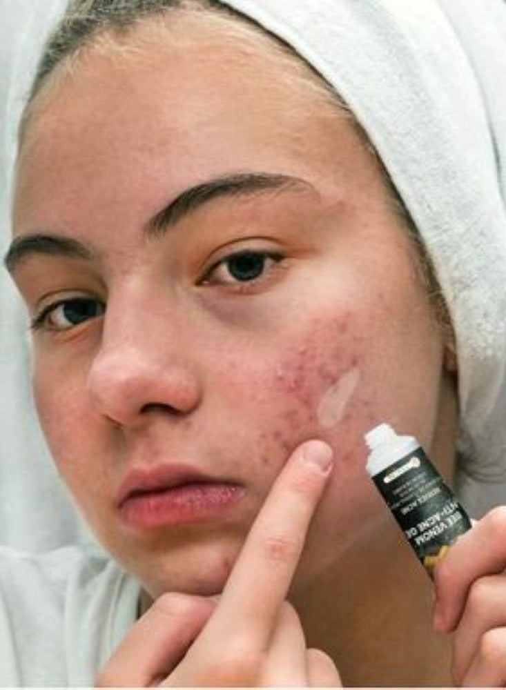 سوميفون جل سوميفون بي فينوم المضاد لحب الشباب، جل إزالة حب الشباب 20 جرام. - Image 4