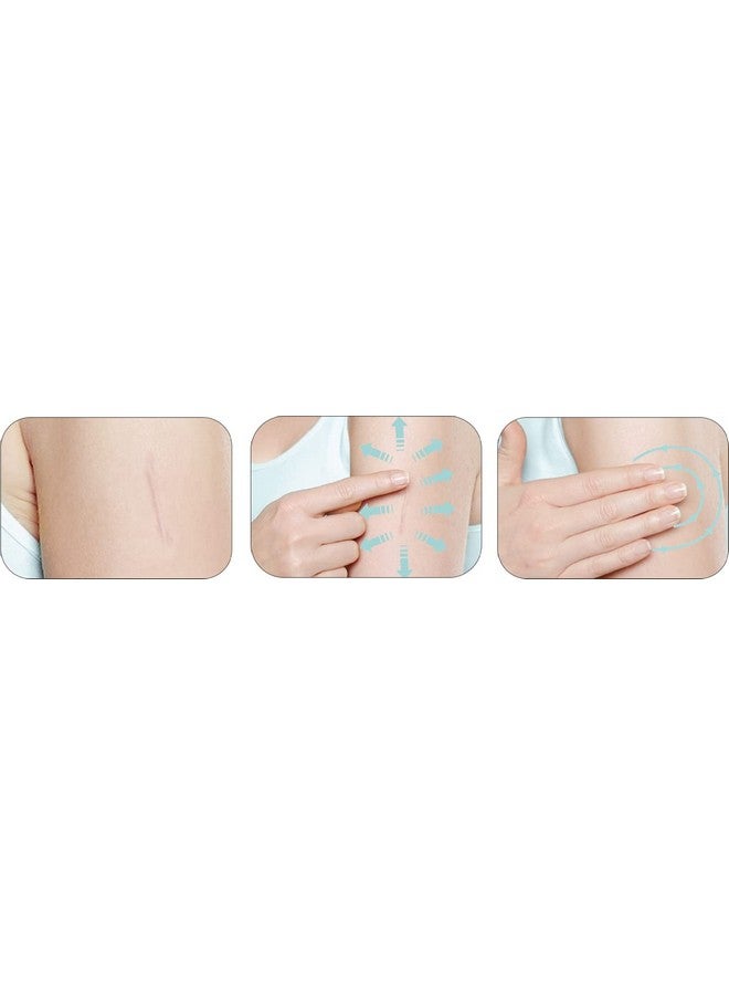 Mederma Skin Care (Helps Scars -Surgery, Injury, Burns, Acne,Stretch Marks) - Image 3