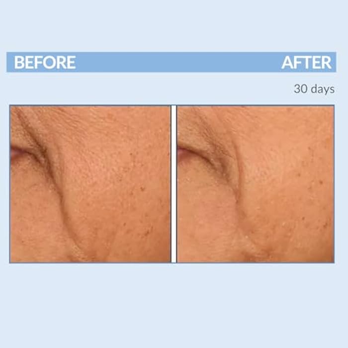 Serious Skincare Retinol Fine Lines and Wrinkles Skin Care Set - A Force XR Serum and A Cream XR Moisture Cream for Face - Anti-Aging - Minimize Post Acne Marks - Resurface and Hydrate - Serious Skincare - Image 5