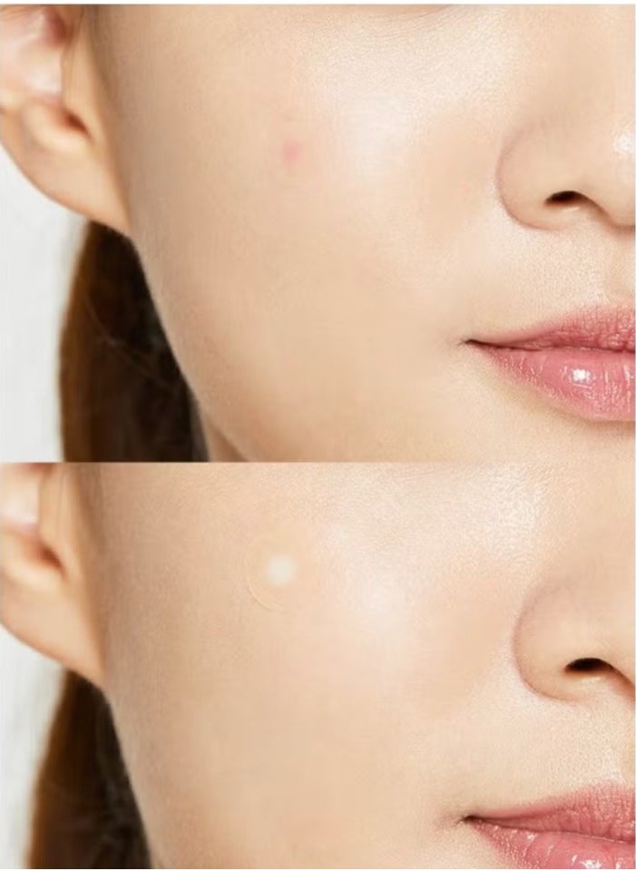 Generic Acne Pimple Master Patch 24 Patches  - Image 4