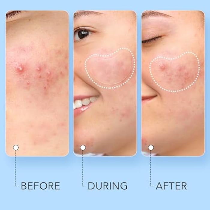 LitBear Acne Pimple Patch, 8 Sizes 140 Pcs Hydrocolloid Acne Patches with Storage Box, 24 XL Pimple Patches for Face, Chin, Nose, 4 Shapes Zits Patches for Blemish, dots with Tea Tree Oil & Cenrella - Image 5