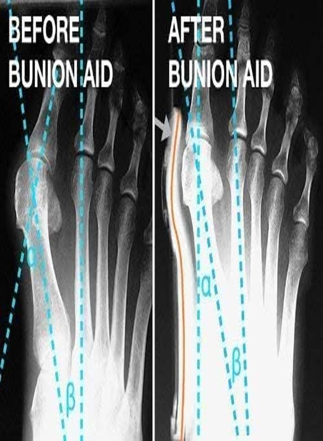 Dkriva فاصل أصابع القدم من دكريفا، واقي من انحراف إبهام القدم. أداة لتعديل القدم، واقي من انحراف إبهام القدم، أداة للعناية بالقدم، سيليكون (زوج واحد) (متعدد الألوان). - Image 3