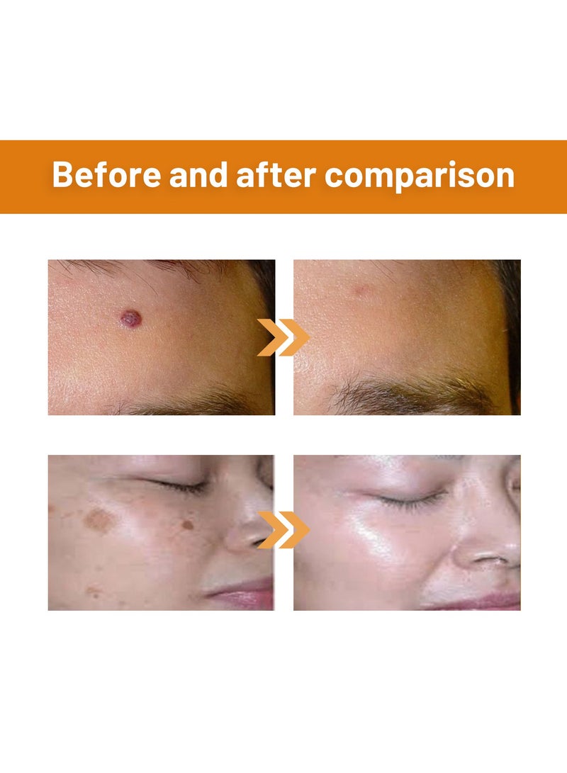 ximonth 3-pack Bee Venom Wart Removal Cream, Improves Pimples, Moles and Repairs Skin 20ml*3 - Image 5